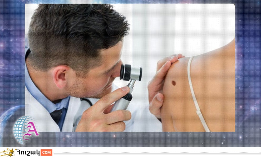 Մարմնի խալերի նշանակությունը (մաս 2)