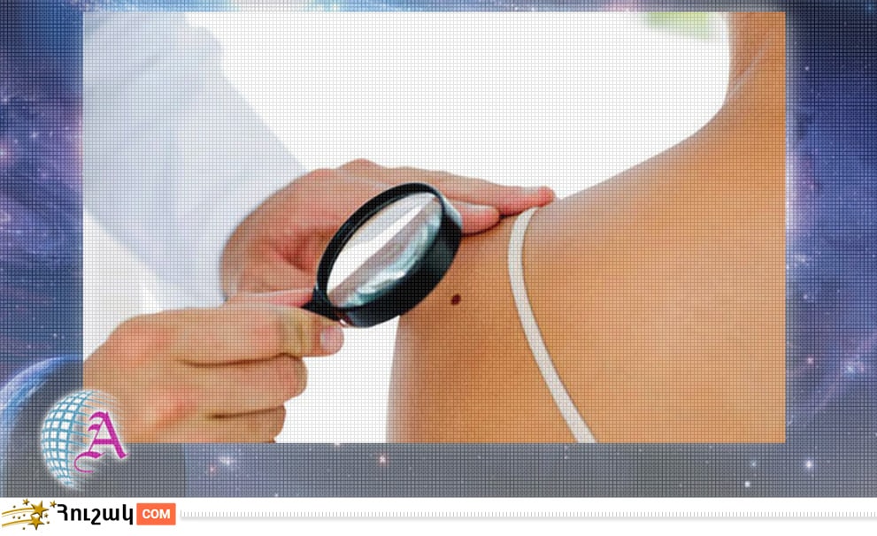 Մարմնի խալերի նշանակությունը (մաս 1)