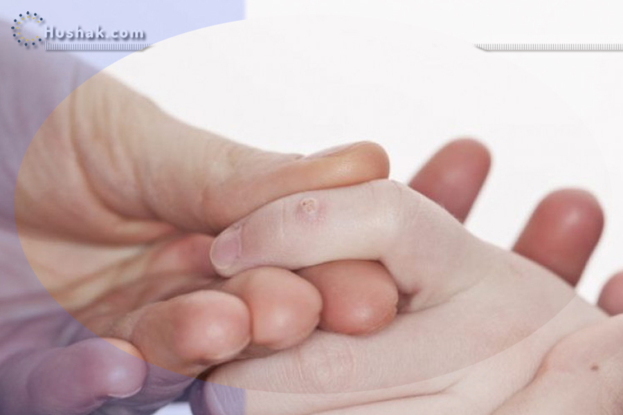 Ժողովրդական բժշկություն. Գորտնուկներից ազատվելու միջոցները