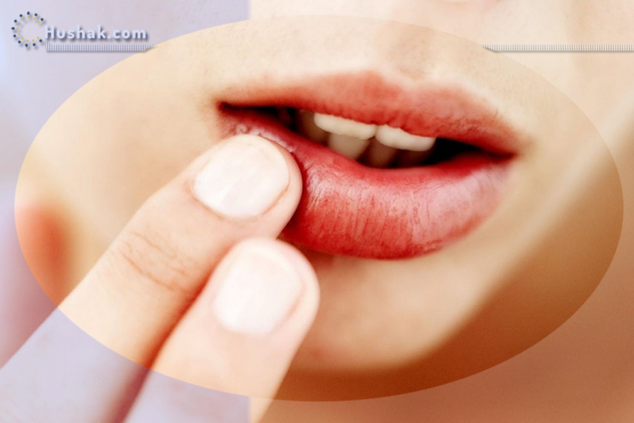 Ժողովրդական բժշկություն. Ժողովրդական միջոցներ հերպեսի դեմ